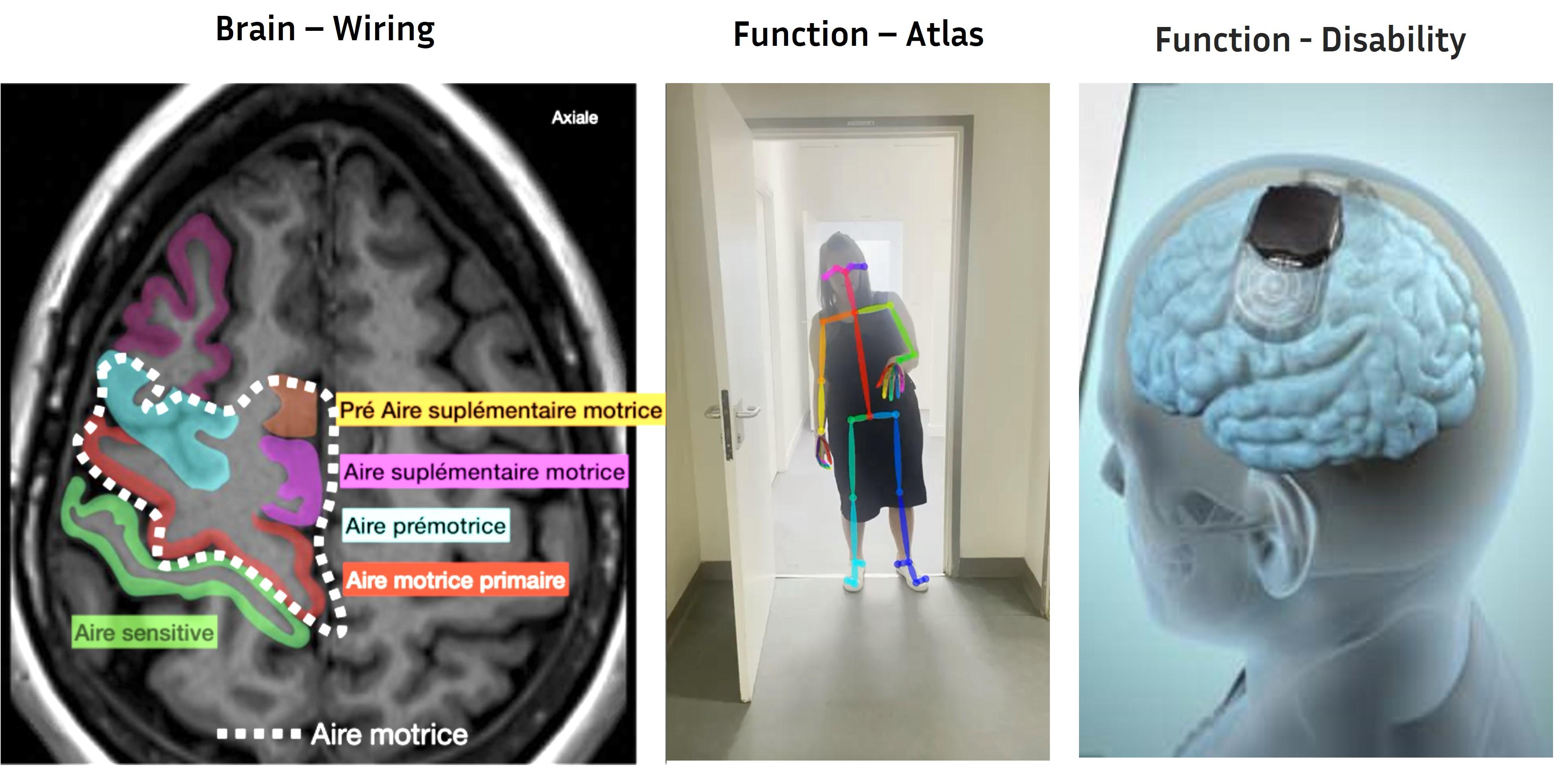 3 visuels : zone identifiée sur une imagerie médicale du cerveau / les mêmes zones dans identifiées sur une personne qui se déplace / une image de la prothèse cérébrale WImagine